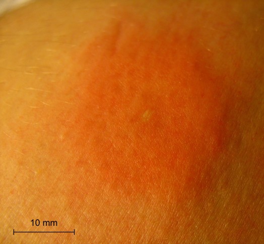Bee stings pictures - bee stings picture (1)