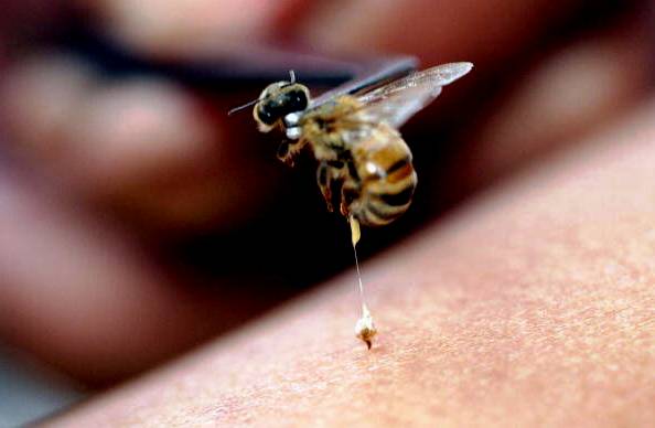 How to treat a bee sting? - MyBeeLine
