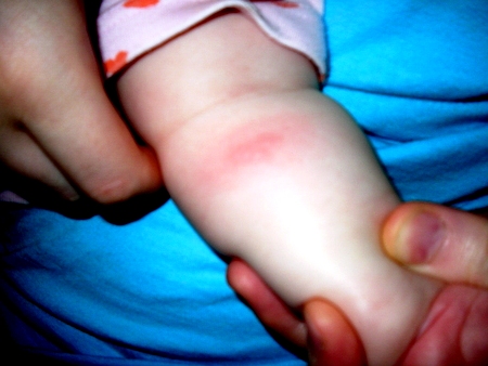 Bee sting allergy - bee sting reactions (1)