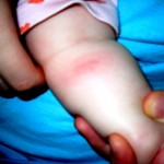 Bee sting allergy - reactions