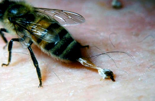 Bee sting symptoms - what to put on a bee sting (5)